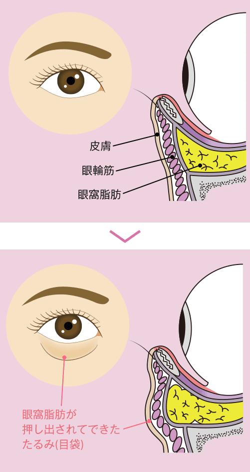 目の下の切らないクマ たるみ ふくらみ 取り 若返り エイジングケアなら湘南美容クリニック 公式