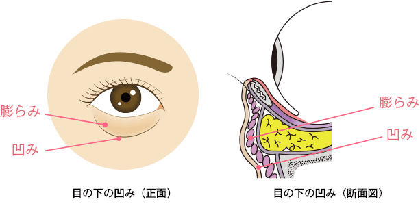 目の下は膨らみと凹みが混在