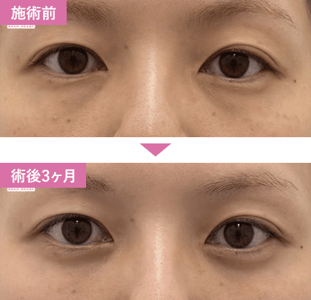 脱脂症例写真1