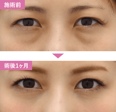 脱脂症例写真2