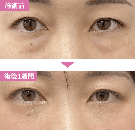 脱脂症例写真3