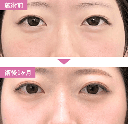 脱脂症例写真4