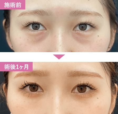 脱脂+脂肪注入症例写真1