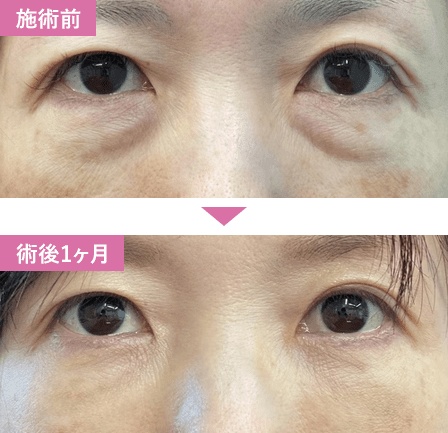 脱脂+脂肪注入症例写真2