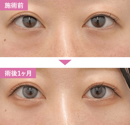 裏ハムラ法症例写真1