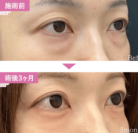 裏ハムラ法症例写真2