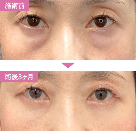 切開ハムラ法症例写真1
