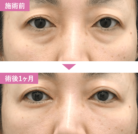 切開ハムラ法症例写真2