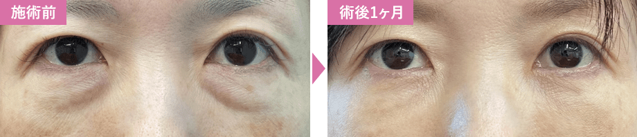 脱脂+脂肪注入症例写真2