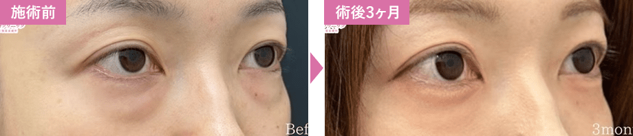 裏ハムラ法症例写真2