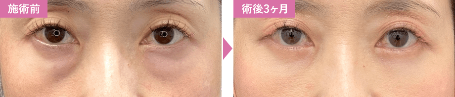 切開ハムラ法症例写真1