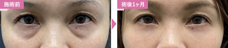 裏ハムラ法症例写真1