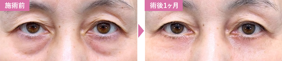 切開ハムラ法症例写真2