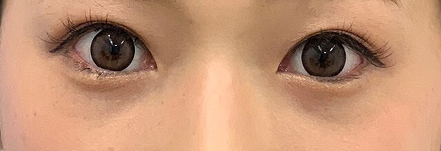 症例写真4 １ヶ月後