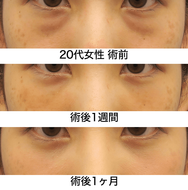 目の下の若返り症例10