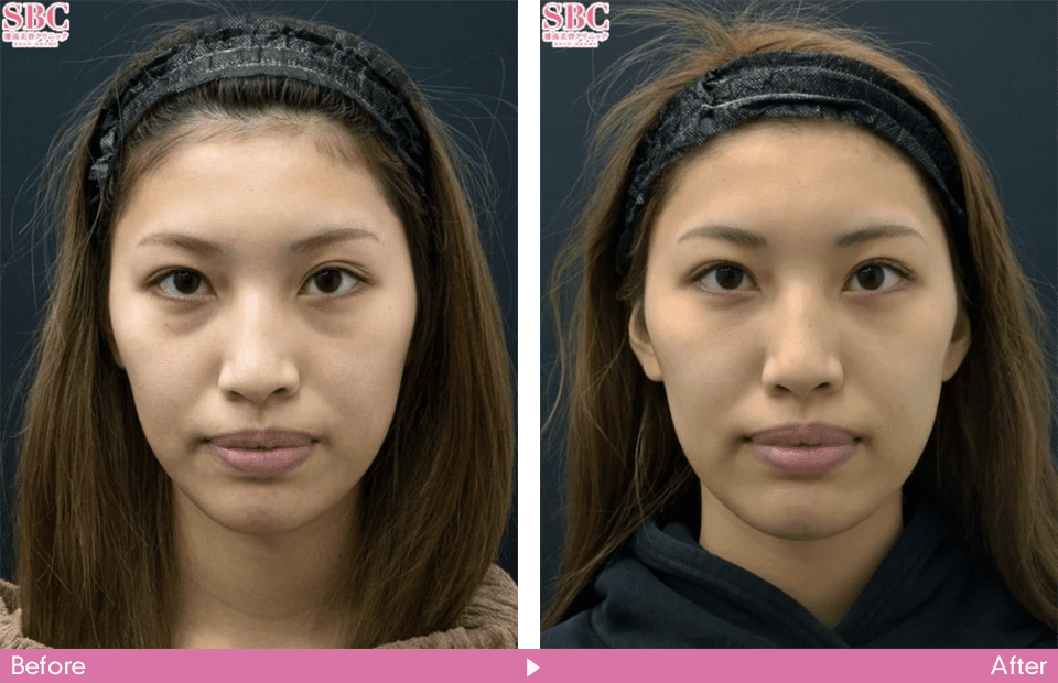 目の下の若返り症例16