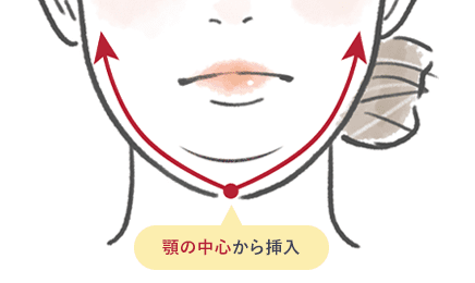 顎下すっきリフト(アンカーDXダブル)と他の糸との違い イメージ1