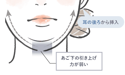 顎下すっきリフト(アンカーDXダブル)と他の糸との違い イメージ2