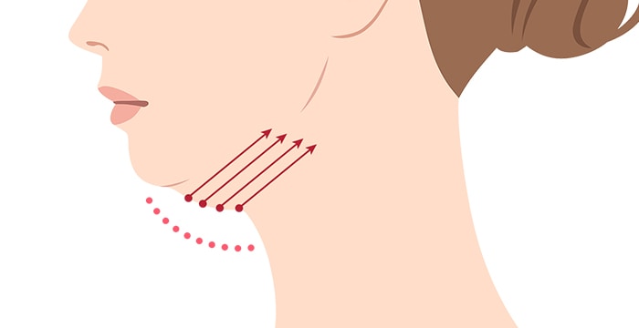 顎下すっきリフト(アンカーDXダブル)の本数の目安 イメージ