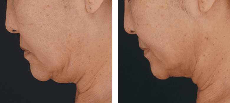 顎下すっきリフト(アンカーDXダブル)症例写真3