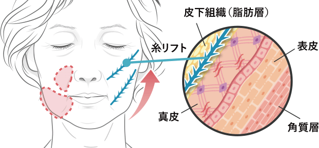 リフトの挿入方法