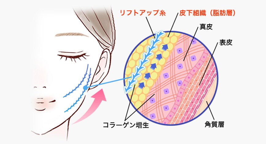 糸リフトとは