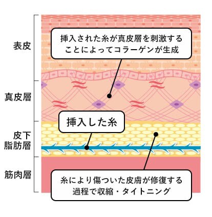 糸リフトの仕組み