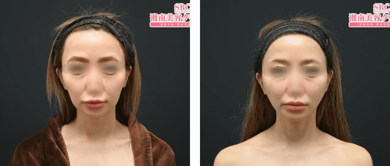 SBCプリマリフトのPickup症例写真3
