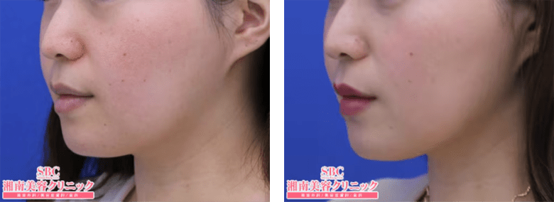 SBCプリマリフトのPickup症例写真4