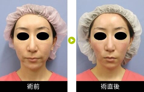 美容 外科 リフト 湘南 糸