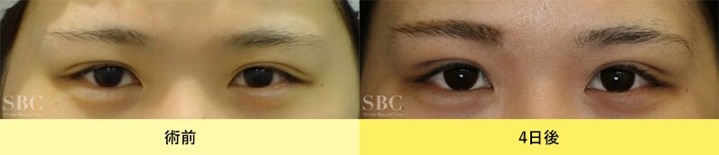 自然癒着セット（まぶたの脂肪取り）症例写真