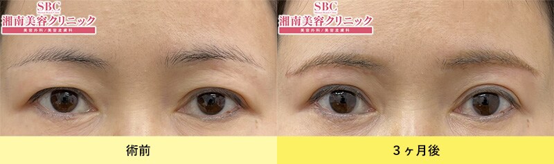 眉下リフト（眉下切開）症例写真