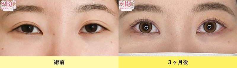 眼瞼下垂症例写真