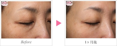 ちりめんじわ(しわ)01