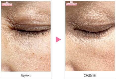 ちりめんじわ(しわ)02