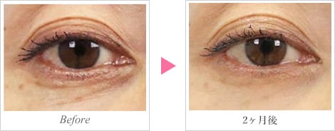 リジュラン注射