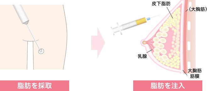 脂肪採取・注入説明イラスト