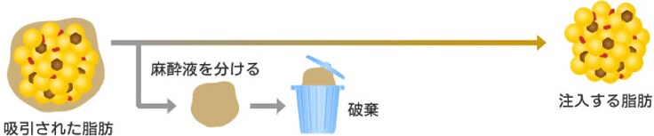 通常の脂肪注入説明イラスト