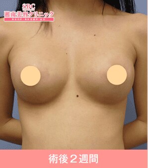 症例写真 術後2週間
