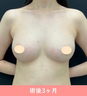 症例写真 術後3ヶ月