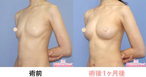 症例写真術後1ヶ月
