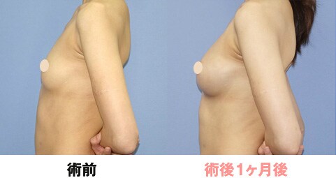 症例写真術後1ヶ月側面