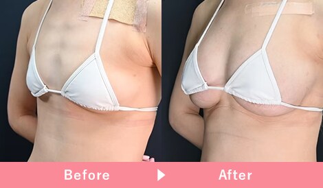 コンデンスリッチ脂肪注入豊胸 症例写真4