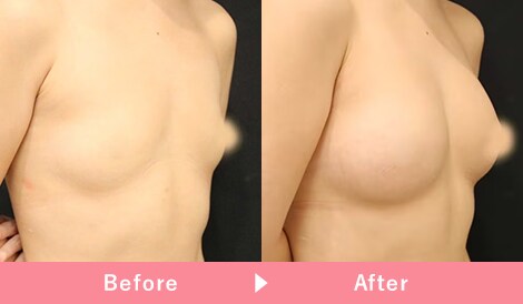 コンデンスリッチ脂肪注入豊胸 症例写真5