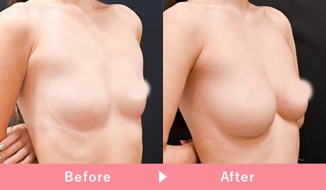 コンデンスリッチ脂肪注入豊胸 症例写真6