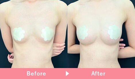 コンデンスリッチ脂肪注入豊胸 症例写真1