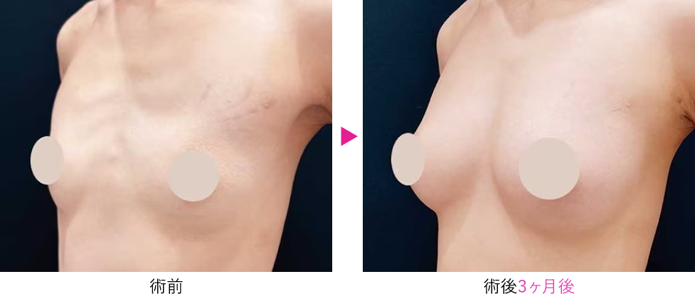 脂肪注入豊胸 コンデンスリッチ脂肪注入豊胸