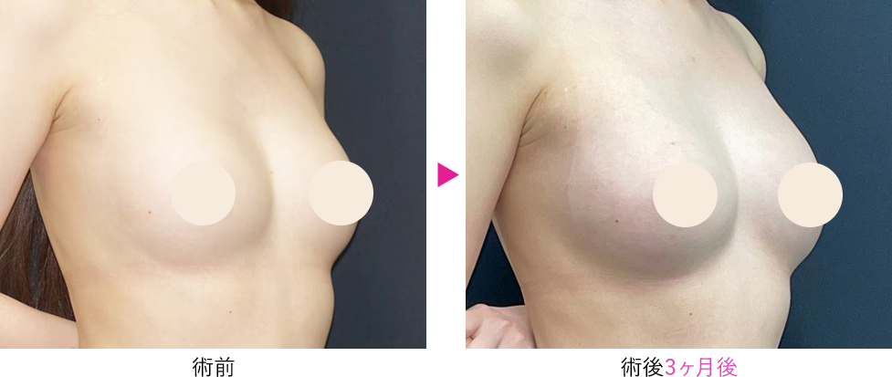脂肪注入豊胸 セルーション脂肪注入豊胸