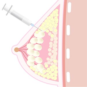 脂肪を注入 イメージ