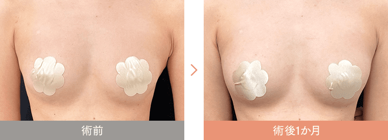 SBCリッチ 症例写真 Before After